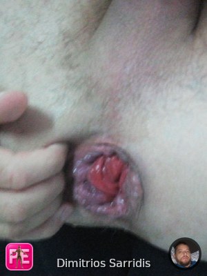 prolapse — Dimitrios Sarridis